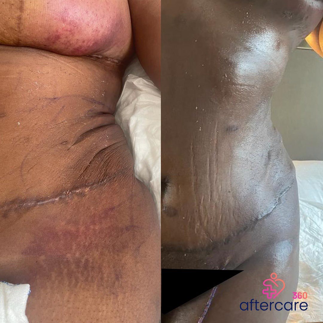 Lymphatic Drainage Massage result